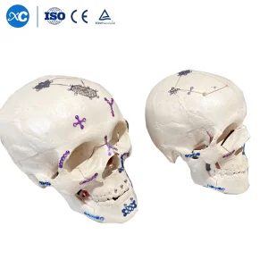 3D Titanium Mesh Restoration