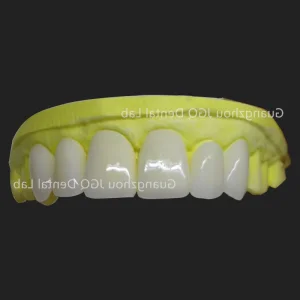 Emax Veneers