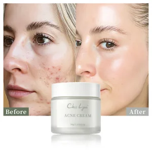 Salicylic Acid Acne Removing Face Cream For Students Acne Removing And Moisturizing Face Cream
