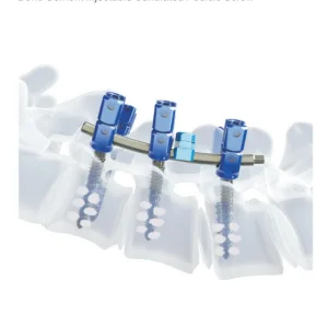 Medical Spine Bone Cement Cannulated Pedicle Screw