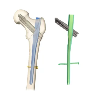 Geasure Intertan Intramedullary Nail Titanium Alloy Orthopedic Implant CE Certified for Proximal Femoral Fracture Treatment