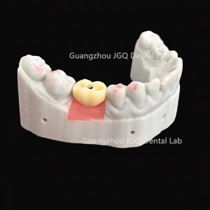 Zirconia Crown Titanium Abutment