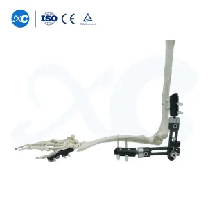 Small Fragment Fixator