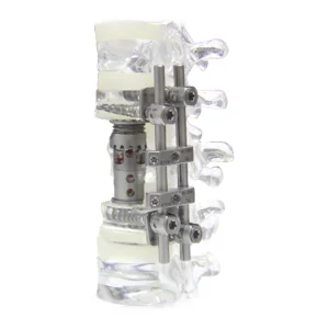Titanium Artificial Vertebral Body