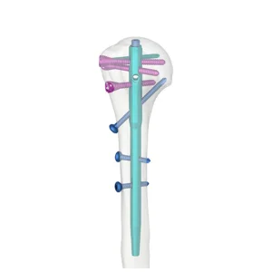 CE Certified Medical-Grade Titanium Alloy Humerus Intramedullary Nail Class III Geasure Brand for Internal Fixation Proximal