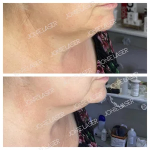 HIFU Ultrasonic Smas Lifting Machine Anti-Aging