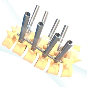 Titanium Artificial Renovation Implant MIS Minimally Invasive Surgery Screws Instruments Orthopedic Surgical Implants Class III