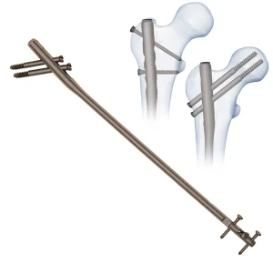 Expert Femoral Intramedullary Nail System