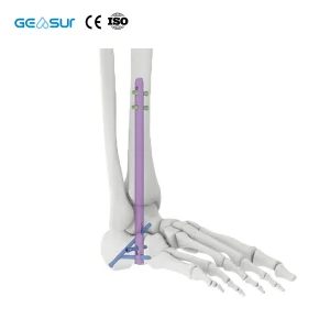 Geasure Titanium Intramedullary Nail 5.0/6.0 Locking Screw-Class III 1-Year Warranty for Ankle Tibial Fracture Fixation