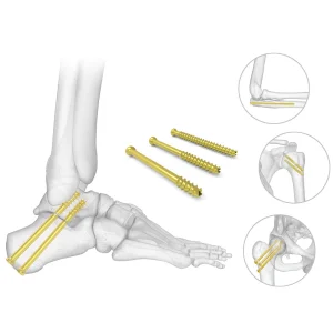 CANWELL Orthopedic Surgical Implants Titanium Herbert Headless 6.5 Cannulated Screw