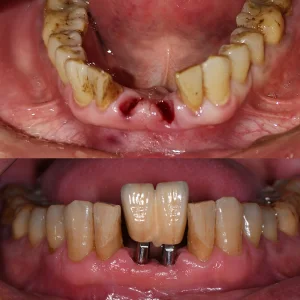 Dental Lab China Custom Implant Front Zirconia Teeth Titanium Abutment 3 Days in Lab