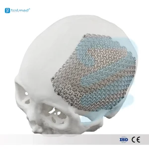 Medical Titanium Mesh Implant
