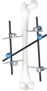 Tibia External Fixator