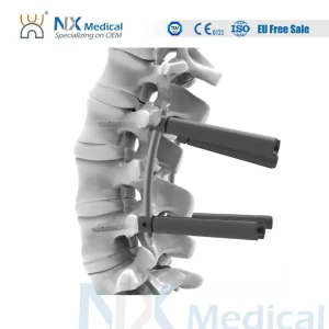 Bone Cement Pedicle Screw