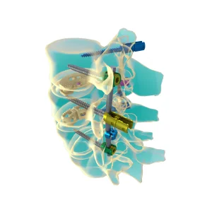 PEEK OLIF Fusion Cage