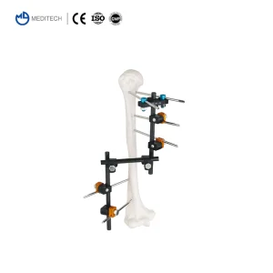 Trauma Orthopedic Implants