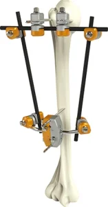 Humerus Fixator