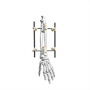 Radius External Fixator