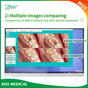 OEM CE Approved Intraoral Rixi Material Instrument Handpiece Advanced Equipment Dental Oral Camera