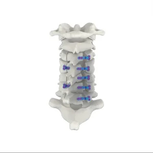Spinal Posterior Cervical Laminoplasty Plate Screw System