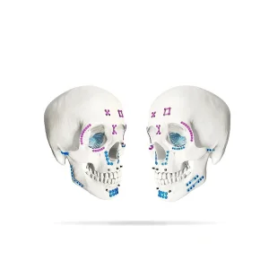 Maxillofacial Plate 1.5mm