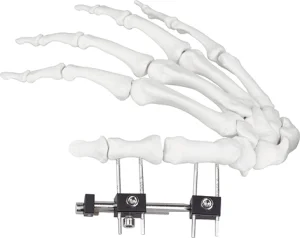 Hand Mini Fixator