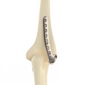 CANWELL Humeral Locking Plate 02 Titanium Distal Lateral Dorsal Anatomical Bone Orthopedic Trauma Fracture Surgery CE OEM Class