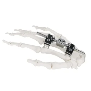 Hand Bone Stent