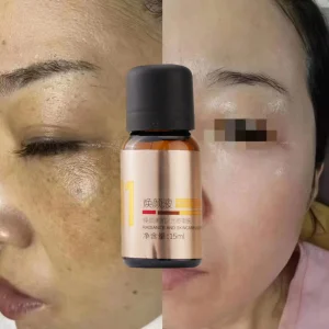 Salicylic Acid Melasma Peel Serum