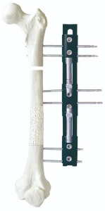 Limb Reconstruction System