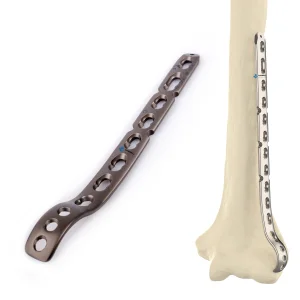 Canwell Distal Humeral Titanium Locking Plate