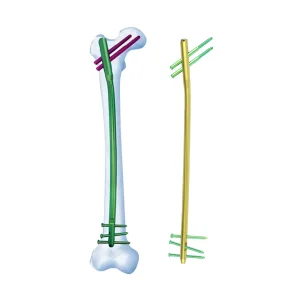 Femoral Intramedullary Nail
