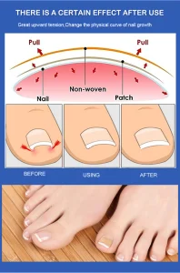 Pedicure Corrector Patch and Nail Correction Tool