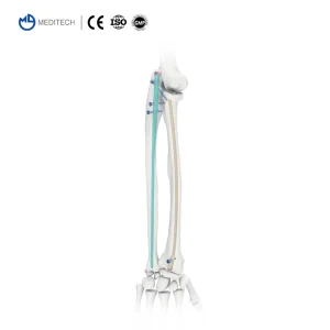 Titanium Bone Implant
