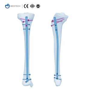 Titanium Interlocking Nail