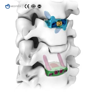 Orthopedic Implant Protesis Spinal Implants Spine Medical Orthopedic Implant Cervical Peek Cage