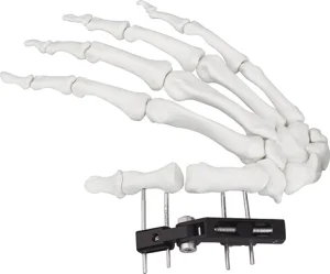 Hand Bone Pin Radius Mini Fixator