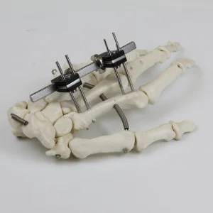Universal Mini Palm Fixator