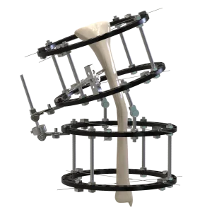 CANWELL AO Illizarov External Fixator