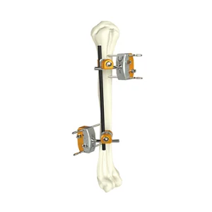 Hoffman Combinationhumeral Shaft External Fixator for Orthopedic Fixation