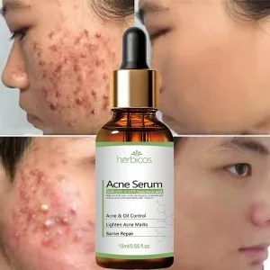 Salicylic Acid Anti Acne Serum