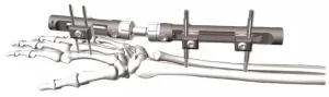Orthopedic Trauma Implant Medical Device Dissection IV (Φ 5) Distal Radius External Fixation