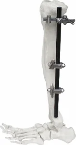 Lightweight External Fixator for Bone Fixation, White &amp; Black Stainless Steel