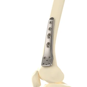 CANWELL Distal Medial Femoral Osteotomy Titanium Locking Plate Orthopedic Implant Trauma Bone Fracture Surgery CE OEM Class III