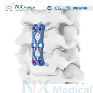Nx Medical Anterior Cervical Plate System Spine Internal Fixation Titanium Minimum Invasive