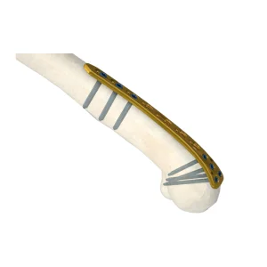 Orthopedic Surgical Titanium Implants Distal Lateral Humeral Locking Plate Trauma Surgery LCP