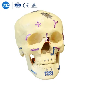 Orthopedic Surgical Neurosurgery Titanium Mesh Cmf Maxillofacial Implants