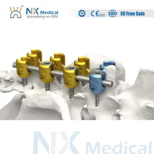 Nx Medical Orthopedic Implant Titanium Sf-III Spinal Pedicle Screw 5.5mm for Bone Fixation
