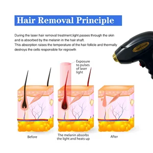 2026 New 2 In1 Diode Laser
