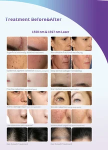 1927nm+1550nm Erbium Thulium Fiber Lasering Machine | Skin Rejuvenation Stretch Marks Removal Skin Tightening Beauty Equipment